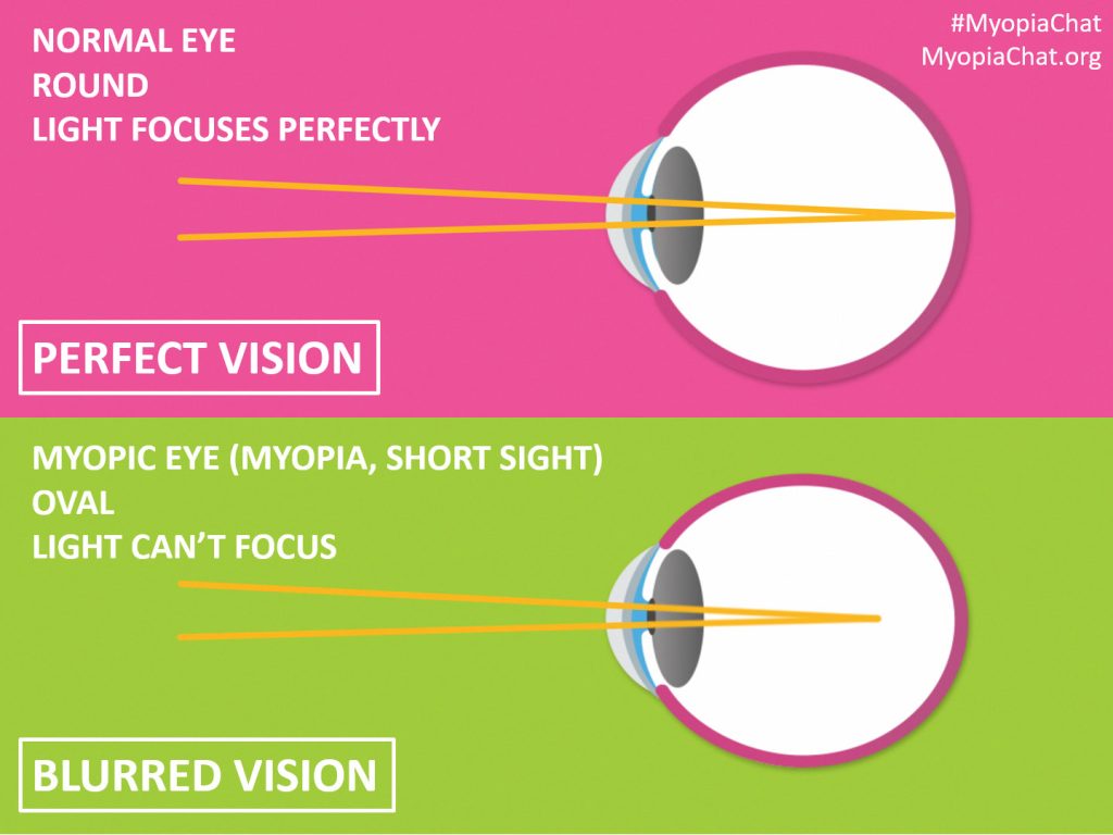 myopiachat - myopic myopia eye vs normal eye